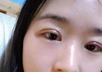 全切双眼皮大概多少钱？全切双眼皮多久能恢复？