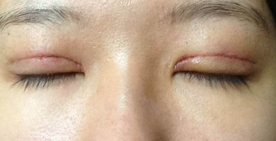 全切双眼皮到底疼不疼？