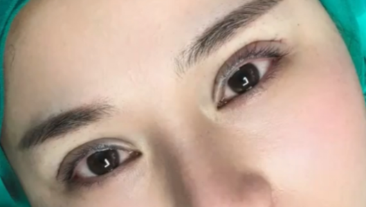 全切双眼皮会消失吗？