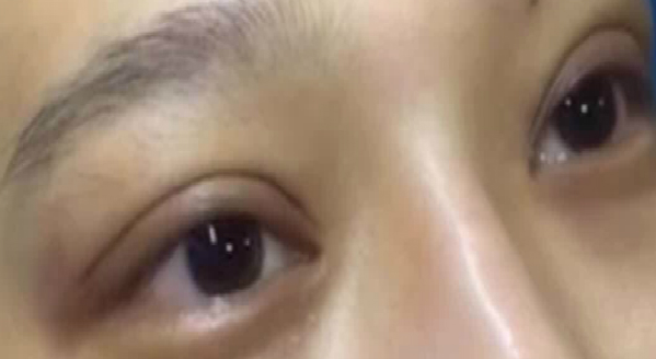 埋线双眼皮大概能保持几年？