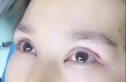 埋线双眼皮有哪些注意事项？