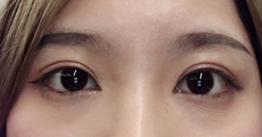 埋线双眼皮几天可以碰水？