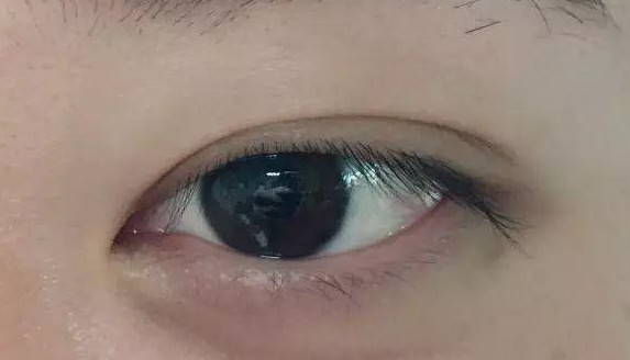 埋线双眼皮有没有危害？
