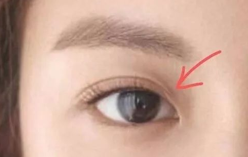 定点双眼皮多久可以化妆？定点双眼皮一般多少钱？