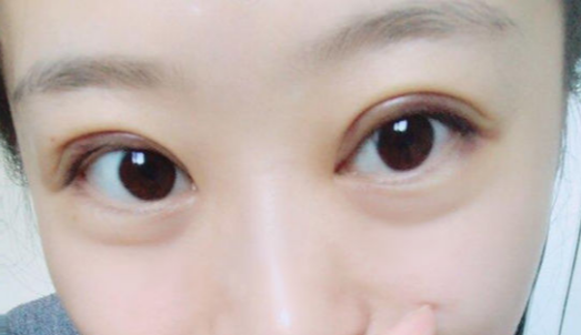 定点双眼皮能维持几年？