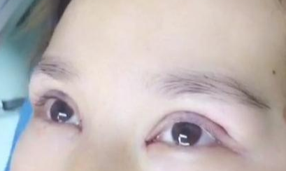 定点双眼皮手术效果自然吗？