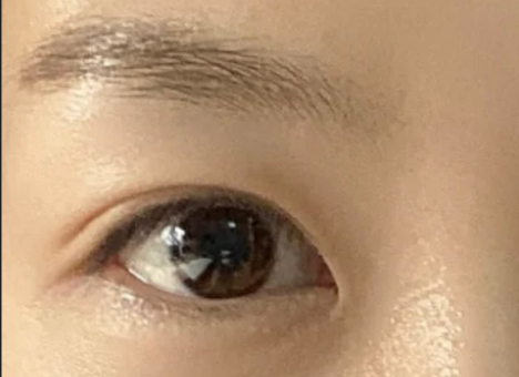 割双眼皮后自然吗？割双眼皮后有危害吗？