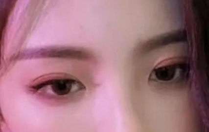 割双眼皮会有疤痕吗？割双眼皮几个月定型？