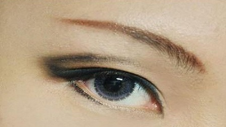 疤痕皮肤可以割双眼皮吗？40岁做埋线双眼皮的效果好不好？