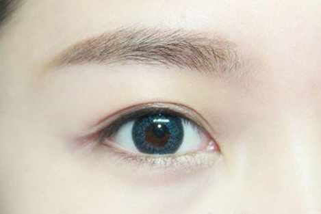 割双眼皮几个月定型？