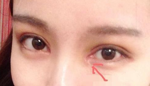 单眼皮开内眼角会留疤吗？