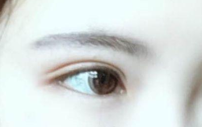 开眼角的恢复期多长？开眼角的后遗症都有什么？
