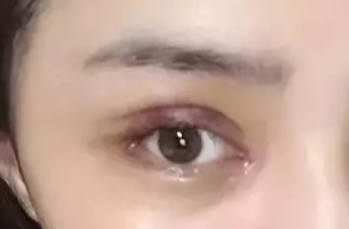 韩式开眼角失败了怎么办？
