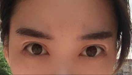 韩式开眼角的有副作用吗？