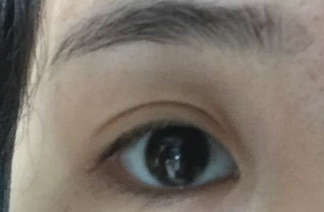 韩式开眼角好吗？