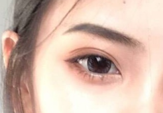开内外眼角有什么坏处？