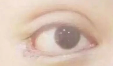 开内眼角的效果好吗？
