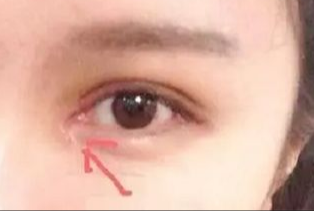 开眼角割双眼皮拆线吗？术后拆线疼吗？