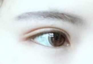 开眼角有几种方法?开眼角有后遗症吗？