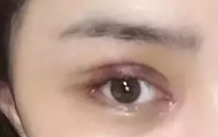 开眼角一般要恢复多久？