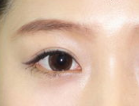 开眼角手术有哪些适应人群呢？开眼角手术有哪些特点？