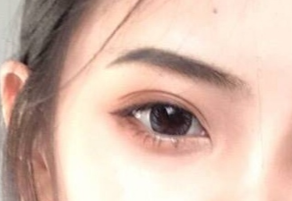 开眼角手术怎么样？开眼角手术怎么做？