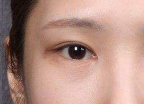 开眼角的术后护理方法有哪些？