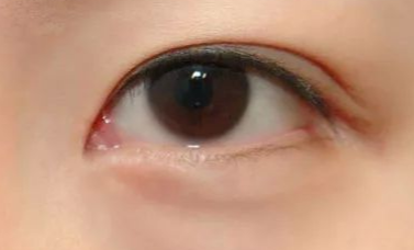 外眼角开大需要多久恢复？外眼角大概需要多少费用？
