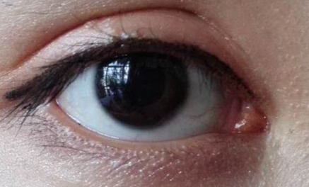 开外眼角什么价格？开外眼角什么时候能好？