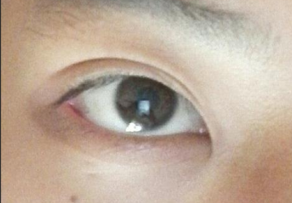 开眼角手术后会影响视力吗？