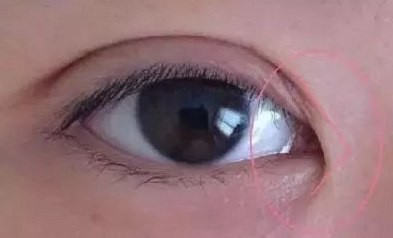 开眼角手术价格要多少钱？
