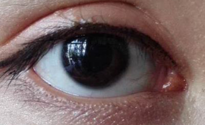 做完开眼角疼不疼？