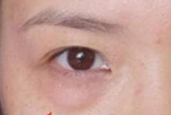 光纤溶脂去眼袋手术有哪些优势？