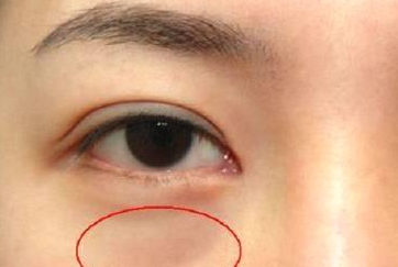光纤溶脂祛眼袋需要多少钱？光纤溶脂怎么样呢？