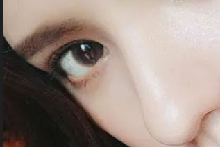 开眼角发红怎么办？