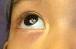 激光祛眼袋需要多少钱？