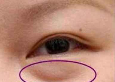 激光去眼袋有什么好处？激光祛眼袋有用吗？
