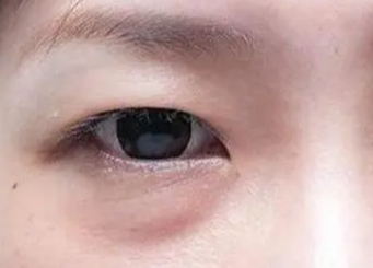 激光祛眼袋有用吗？