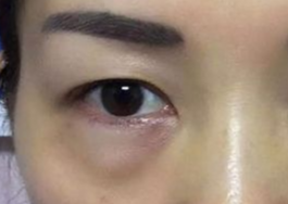 激光可以祛眼袋吗？激光祛眼袋有哪些副作用？