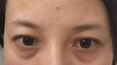 激光祛除眼袋有效吗？