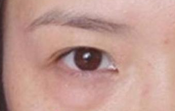 激光去除眼袋后遗症有哪些？