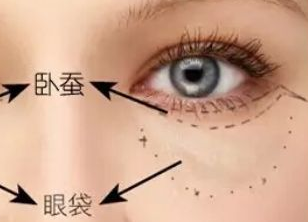 激光去眼袋多久才能恢复？激光去眼袋有什么副作用吗？