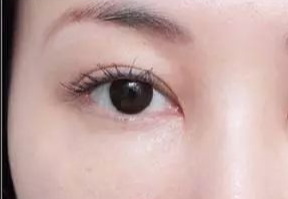 激光去眼袋什么人适合？