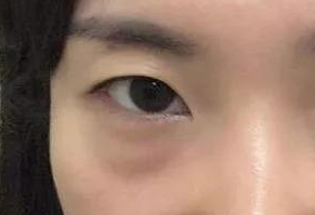 激光祛眼袋会疼吗？激光去眼袋手术好吗？