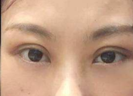 激光去眼袋可保持多久？激光去除眼袋效果好不好？