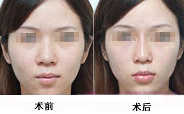 鼻头缩小手术是怎么做的？术后应该怎么护理