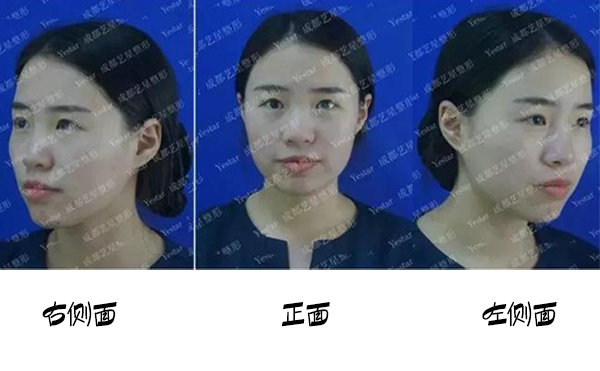 福州名韩整形改善蒜头鼻大概要花多少钱？