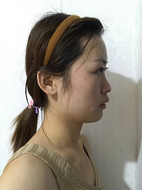 天津伊美尔超肋鼻综合案例大赏