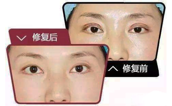 哪些情况需做双眼皮修复？修复难度大不大?