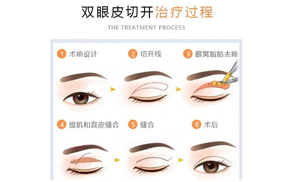割双眼皮改善肿眼泡有什么优势?术后有什么并发症?